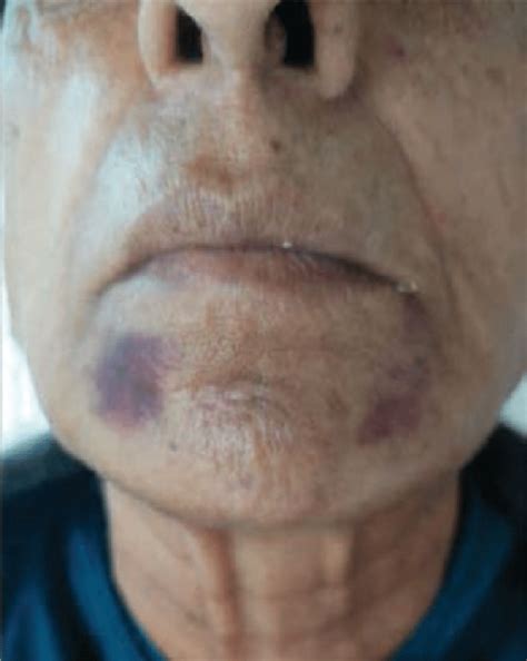 1 It may be a complete <b>occlusion</b> or partial <b>occlusion</b>, resulting in a diminished blood supply. . Vascular occlusion or bruise
